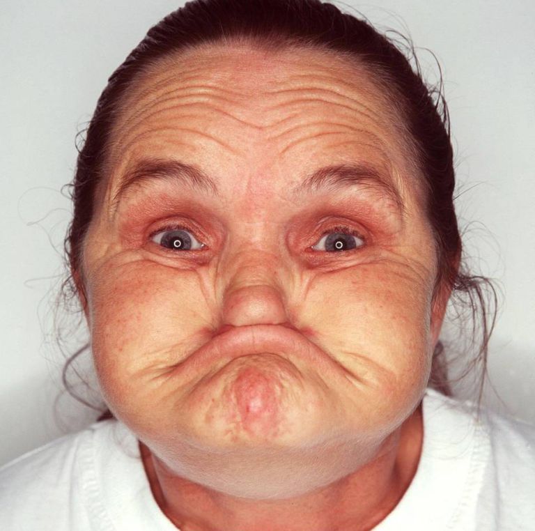 La "femme la plus moche du monde" est décédée