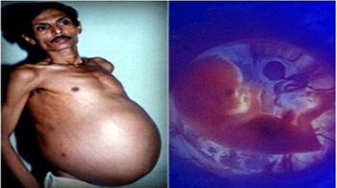 Un homme "enceinte" accouche de son frère