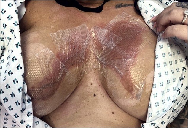 Royaume-Uni : La peau de ses faux seins fond après s’être ébouillantée