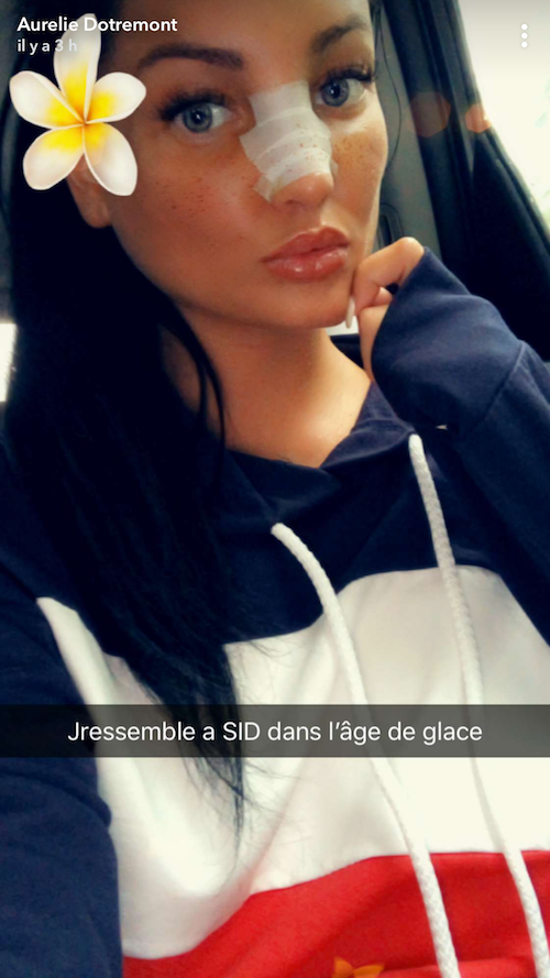 Aurélie Dotremont après sa rhinoplastie : « Je ressemble à Sid de l'Age de Glace »