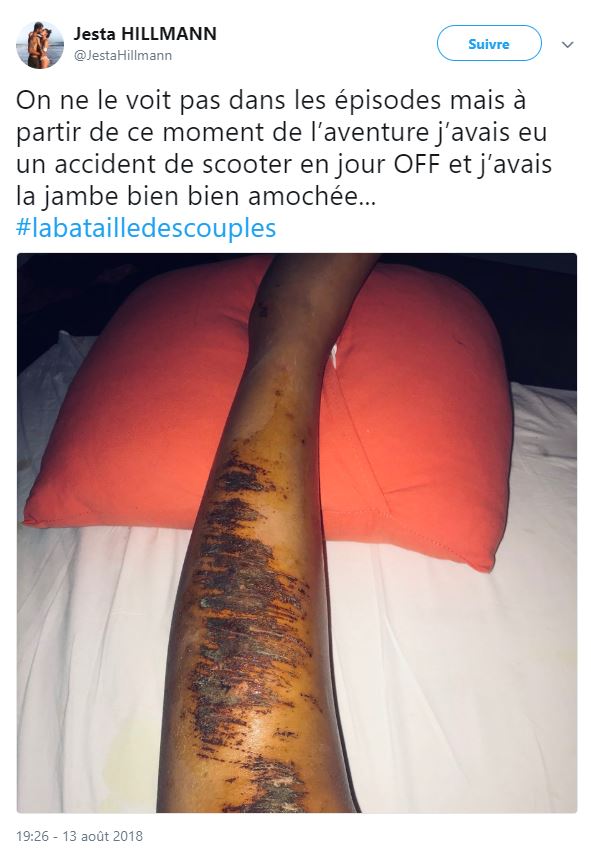 Jesta victime d'un accident sur le tournage de la Bataille des couples : Elle dévoile ses blessures