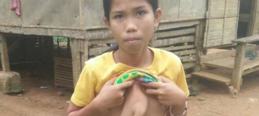 Philippines : À 14 ans, elle vit avec les bras de sa jumelle parasite sur sa poitrine