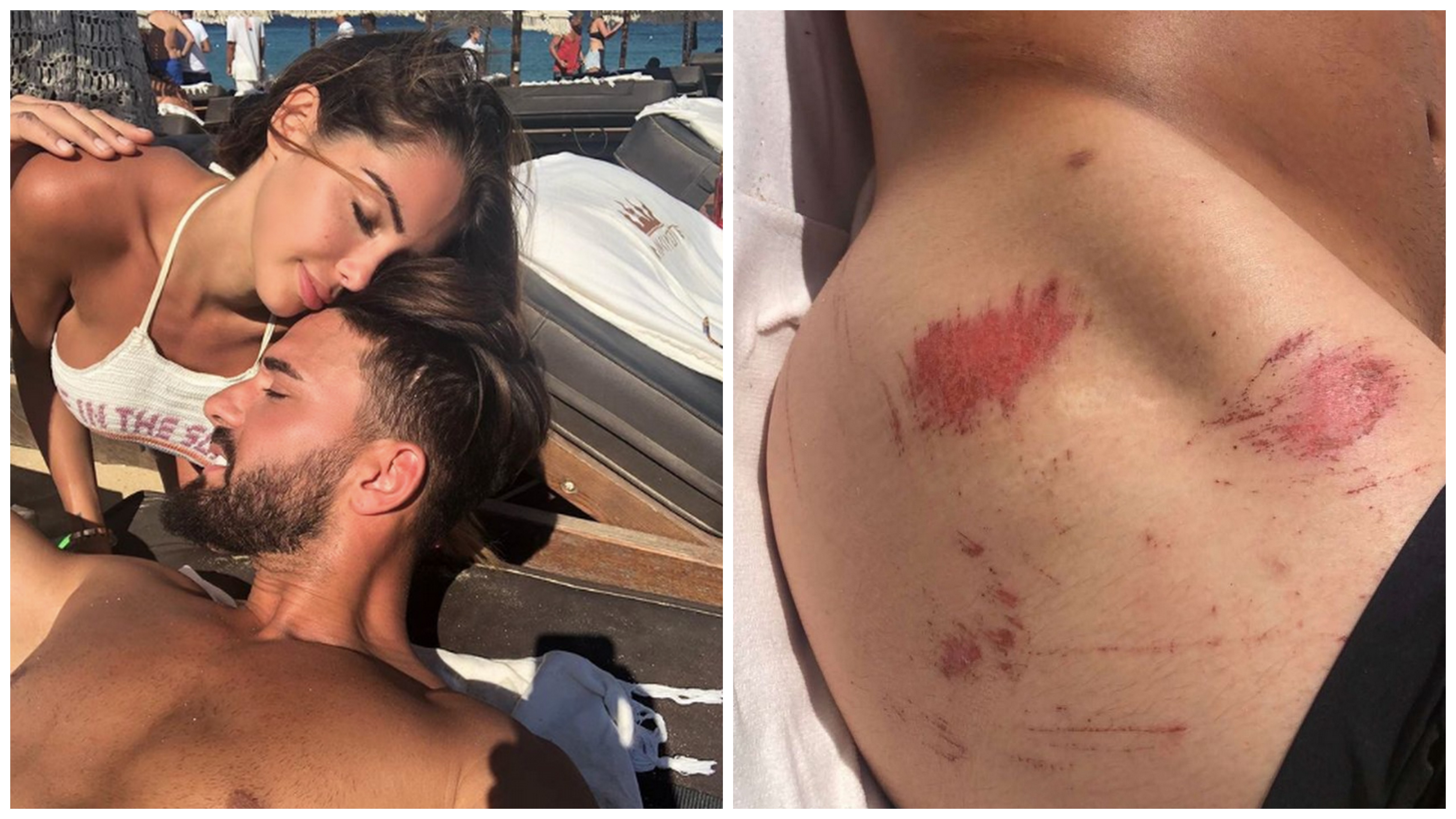 Thomas Vergara : Victime d'un accident de scooter, Nabilla Benattia dévoile les clichés de ses blessures !