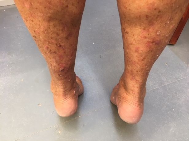 Accro au bronzage, une ancienne reine de beauté lutte désormais contre un cancer de la peau