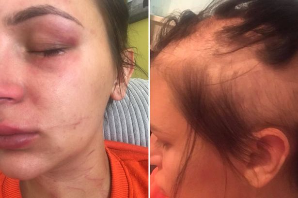 Angleterre : Victime d’une violente agression, une jeune maman se retrouve presque chauve