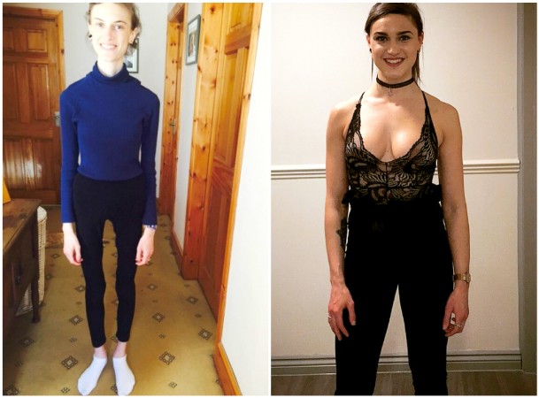 Découvrez l'incroyable transformation de cette jeune femme diagnostiquée anorexique