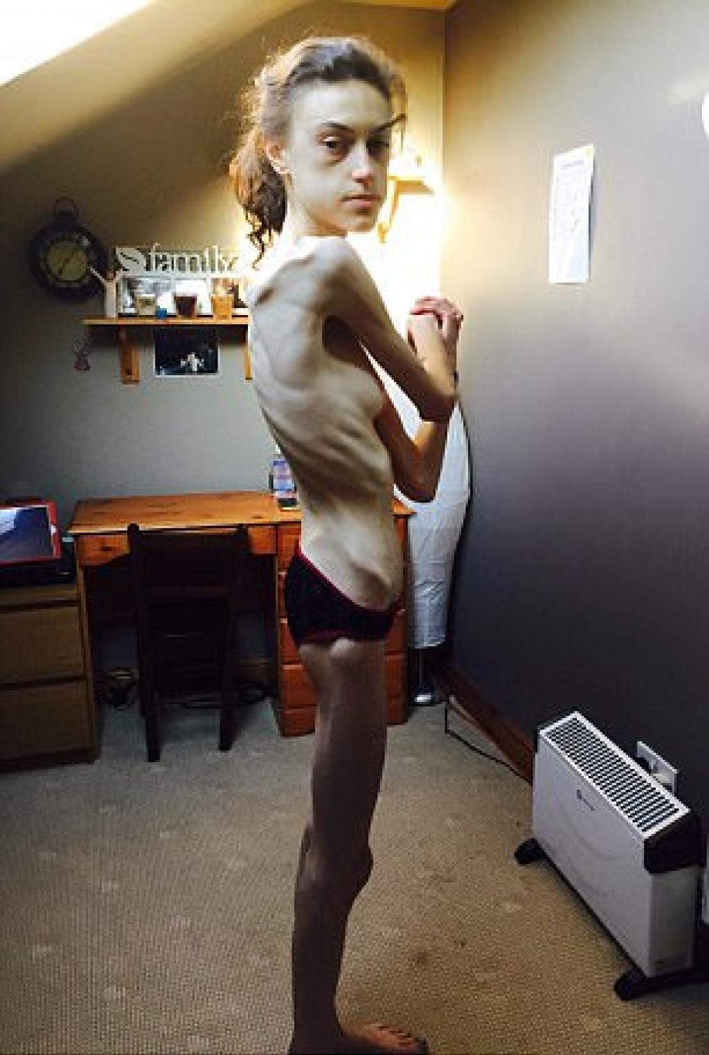 Découvrez l'incroyable transformation de cette jeune femme diagnostiquée anorexique