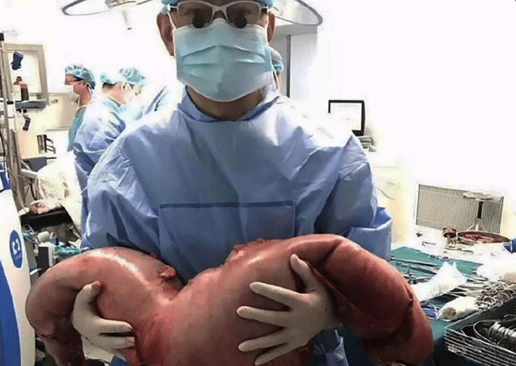Un médecin enlève 13 kilos d'excréments d'un patient constipé !