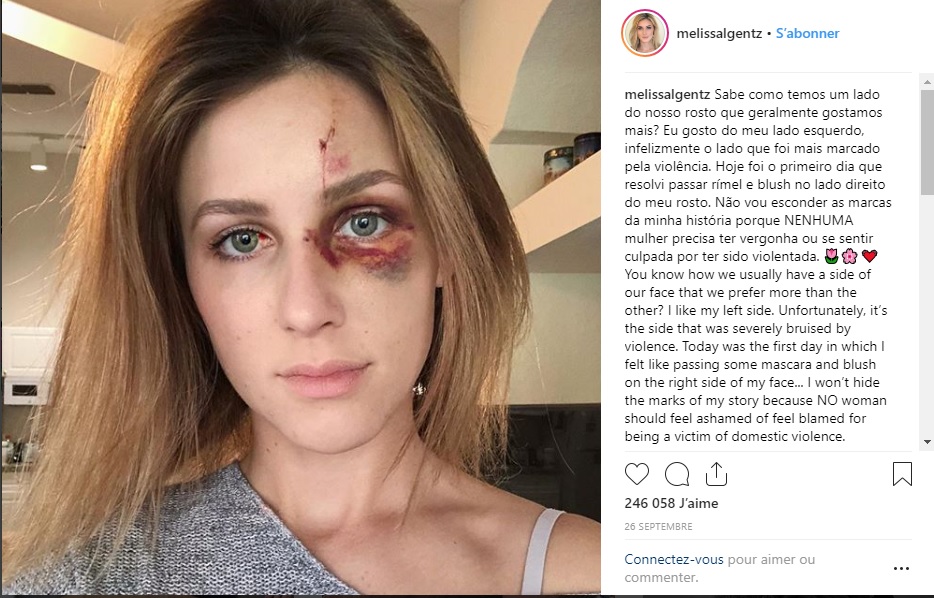 Etats-Unis : Les photos d'une influenceuse battue par son petit ami deviennent virales