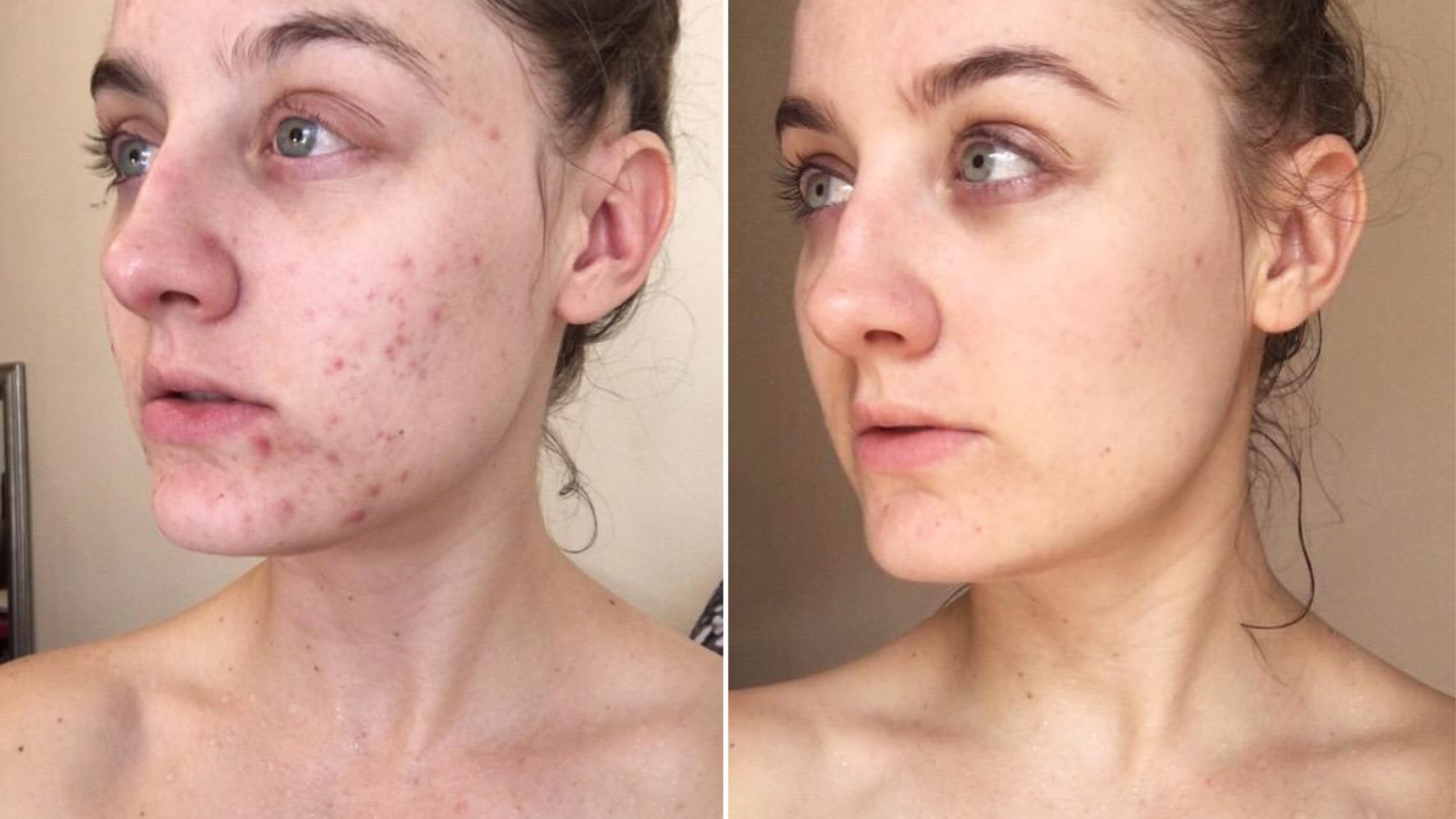 Une femme cesse de se laver le visage pendant 6 mois et publie une photo avant/après