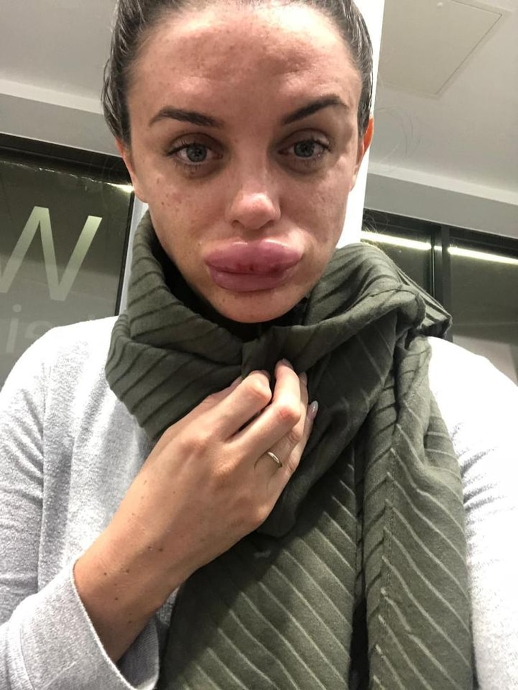 Une jeune femme défigurée lors d’une soirée Botox