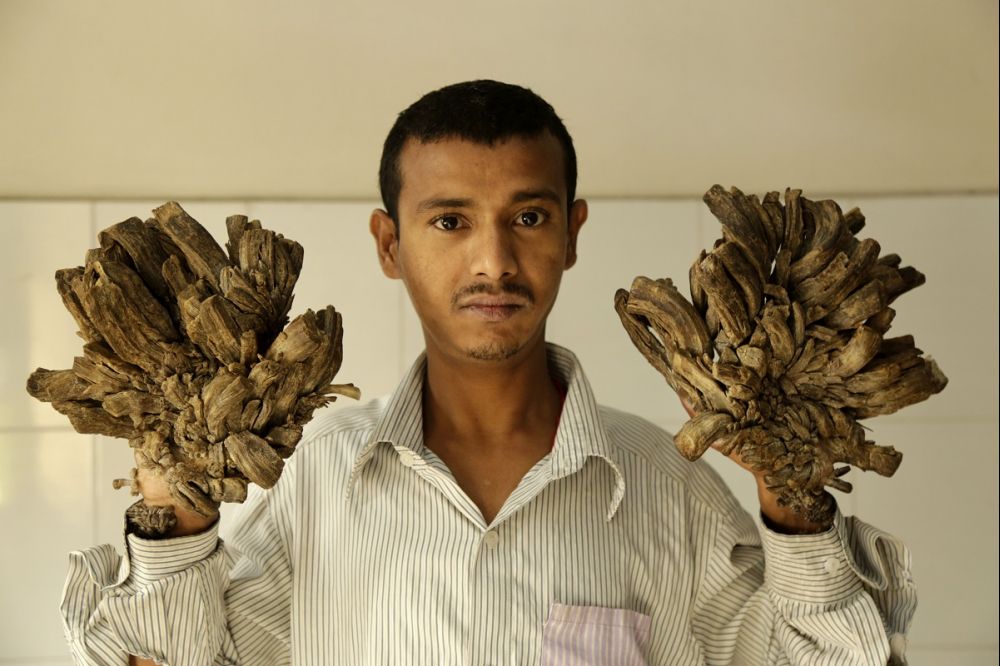 Bangladesh : « l’homme-arbre » de nouveau opéré, sa condition s'est détériorée  !