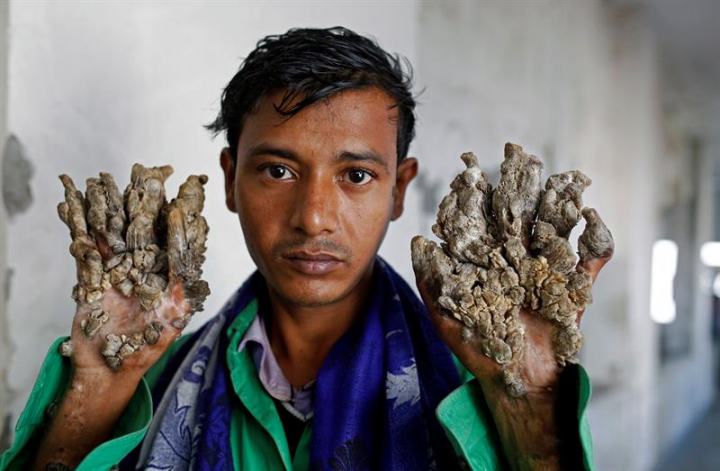 Bangladesh : « l’homme-arbre » de nouveau opéré, sa condition s'est détériorée  !