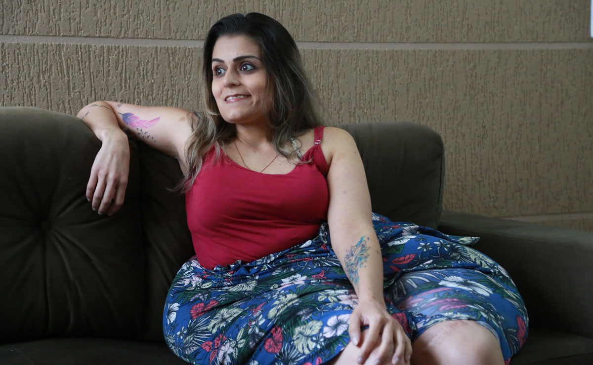 Brésil : cette femme vit avec des tumeurs de 4 kilos sur les jambes