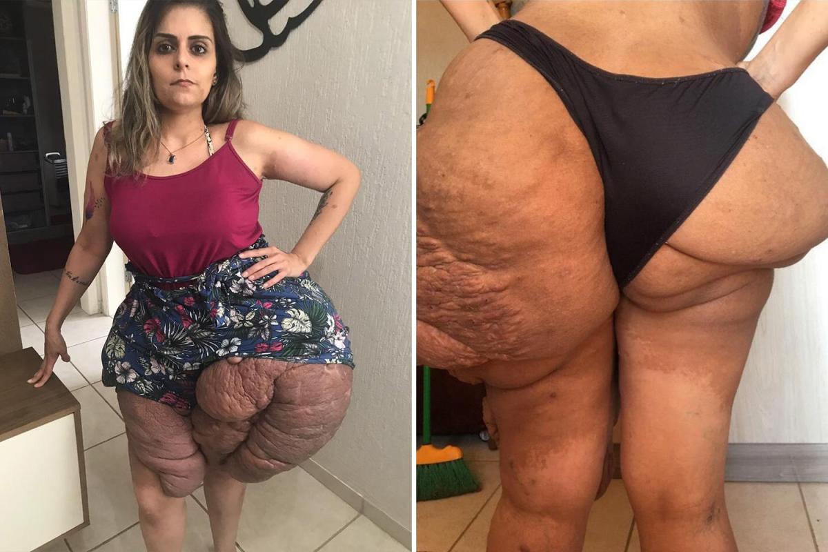 Brésil : cette femme vit avec des tumeurs de 4 kilos sur les jambes