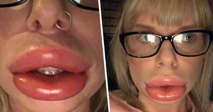 Réaction allergique : Ses lèvres doublent de volume après l’application d’un produit de beauté