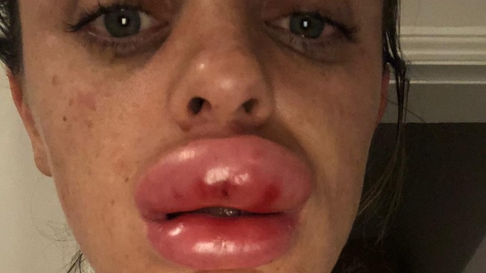 Royaume-Uni : Ses lèvres quadruplent de volume après une injection de botox ratée !