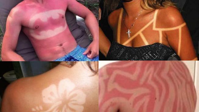 Se tatouer grâce à des coups de soleil, cette tendance dangereuse qui revient à la mode