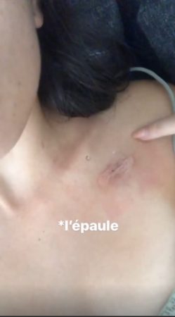 Agathe Auproux dévoile l'impressionnante cicatrice de son cathéter