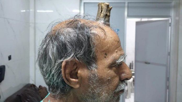 Inde : Une corne de dix centimètres lui poussait sur le crâne