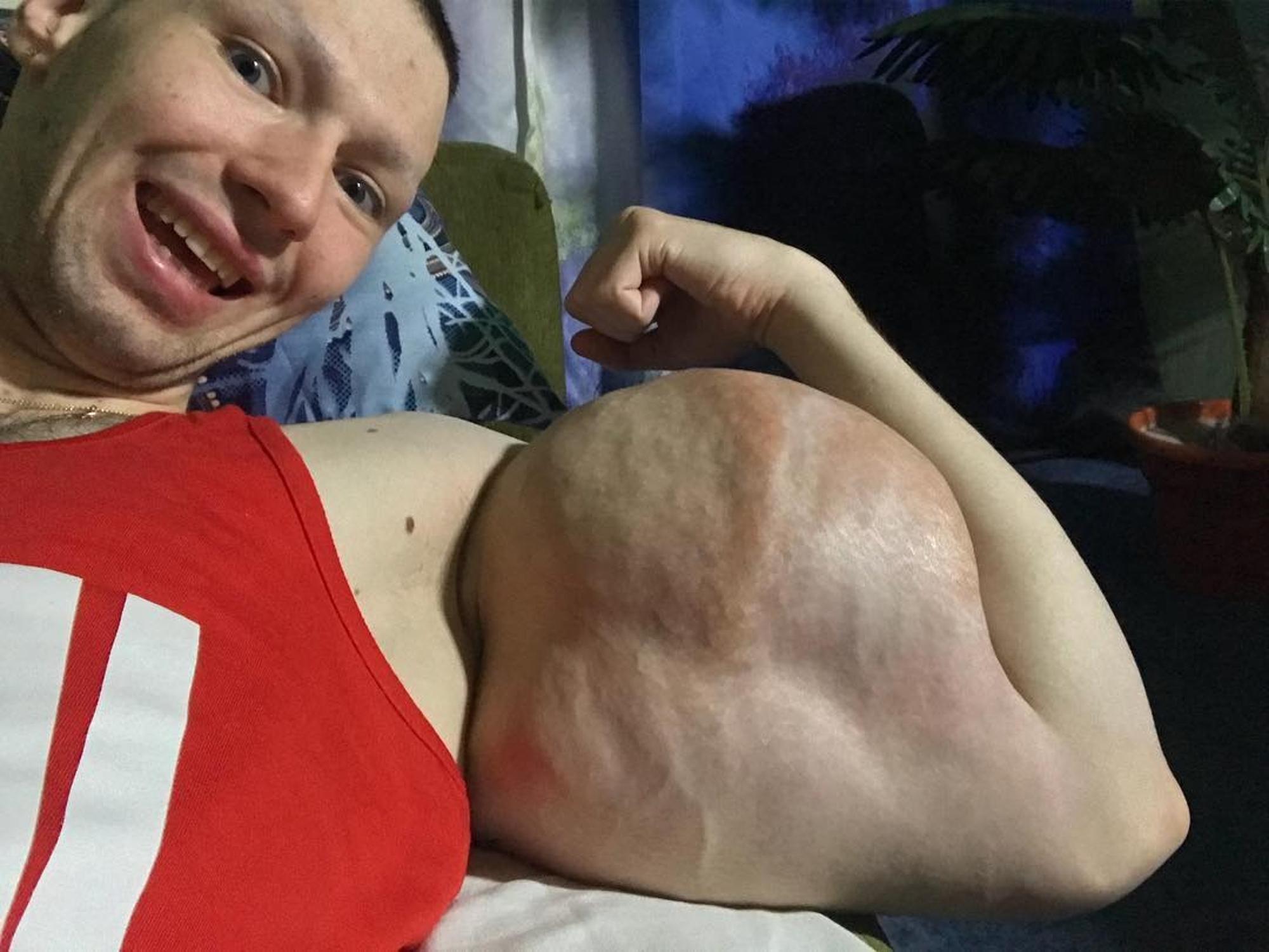 Kirill Tereshin : Le Hulk russe se fait retirer 3 litres de vaseline des bras