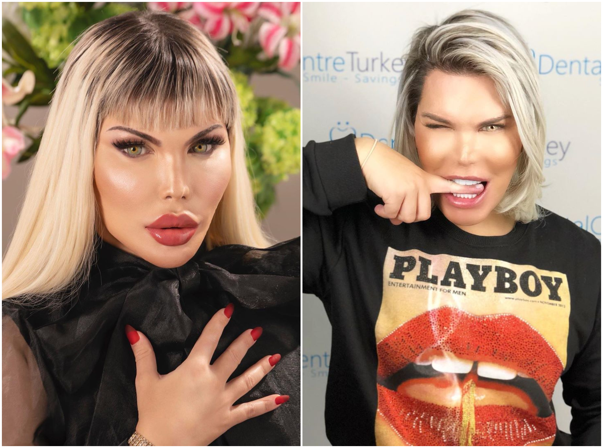 Rodrigo Alves : Ken devenu Barbie dévoile ses nouveaux implants