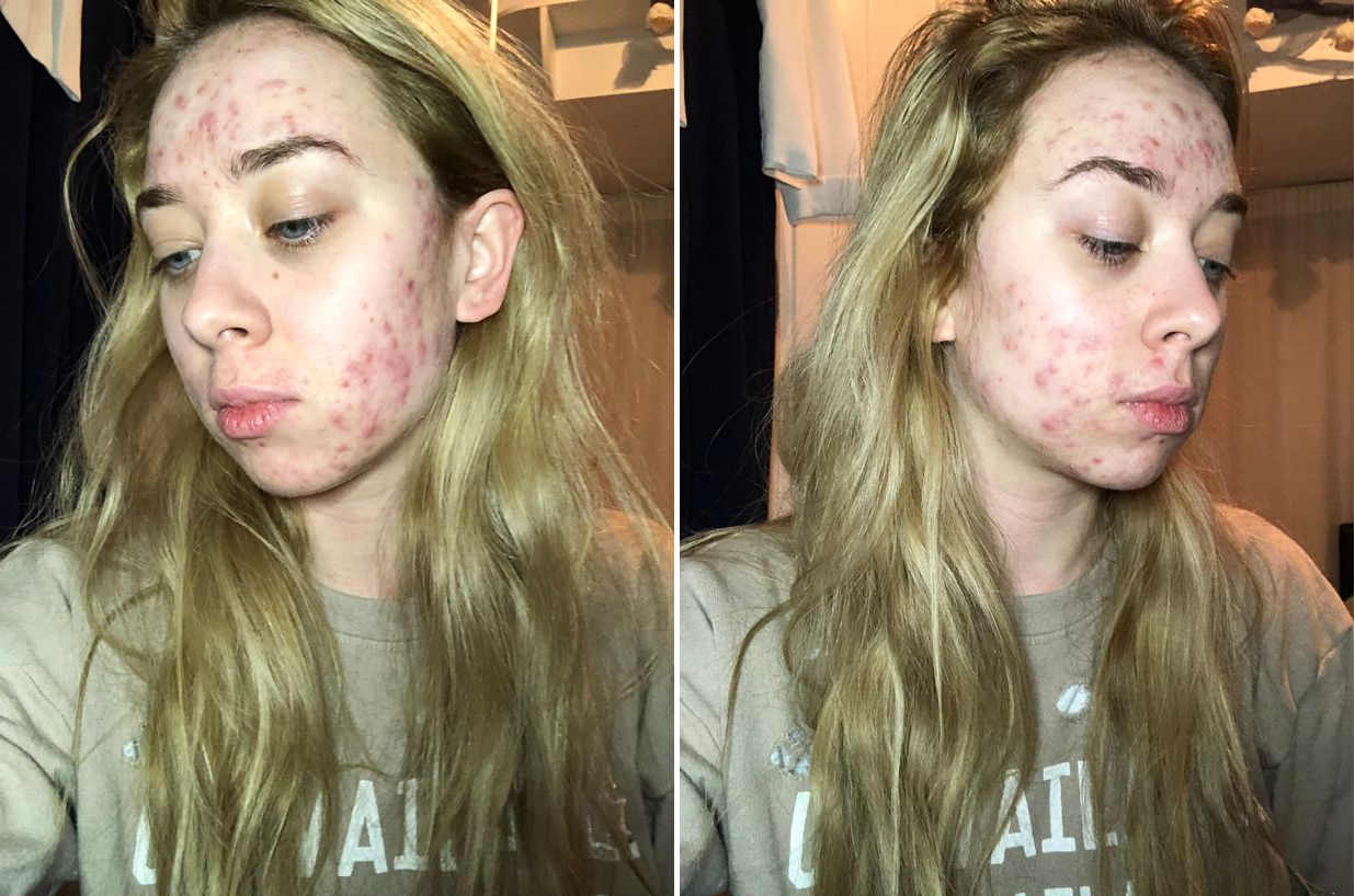 Acné : Elle dévoile son visage sans maquillage et choque les ...