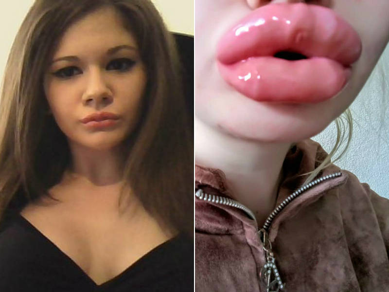 Elle subit une 20ème injection pour avoir les plus grosses lèvres au monde
