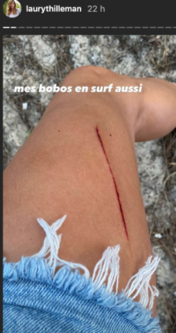 Laury Thilleman victime d'un petit accident, elle se blesse en surf !