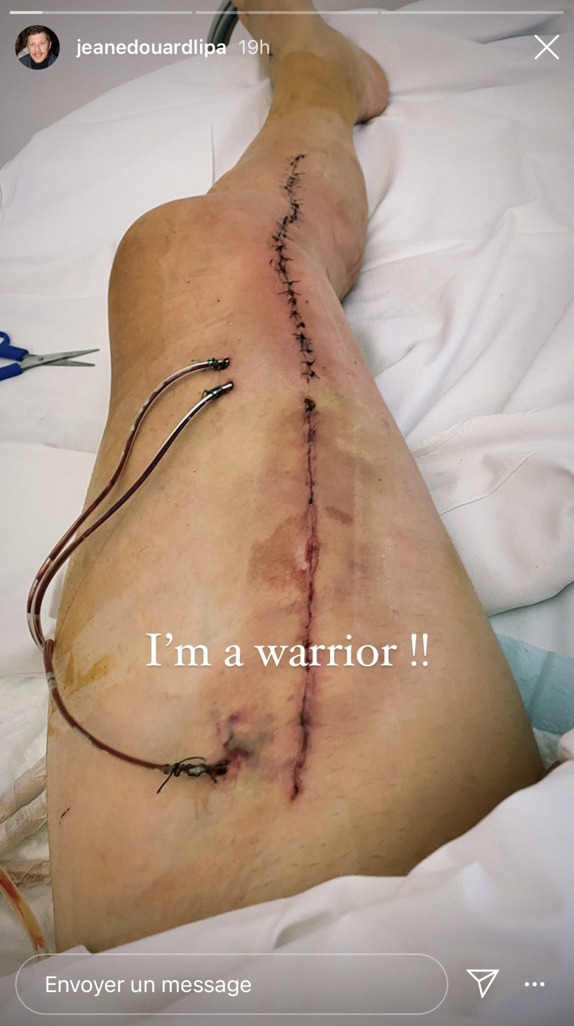 Jean-Edouard Lipa opéré : sa jambe est sauvée mais la cicatrice est impressionnante