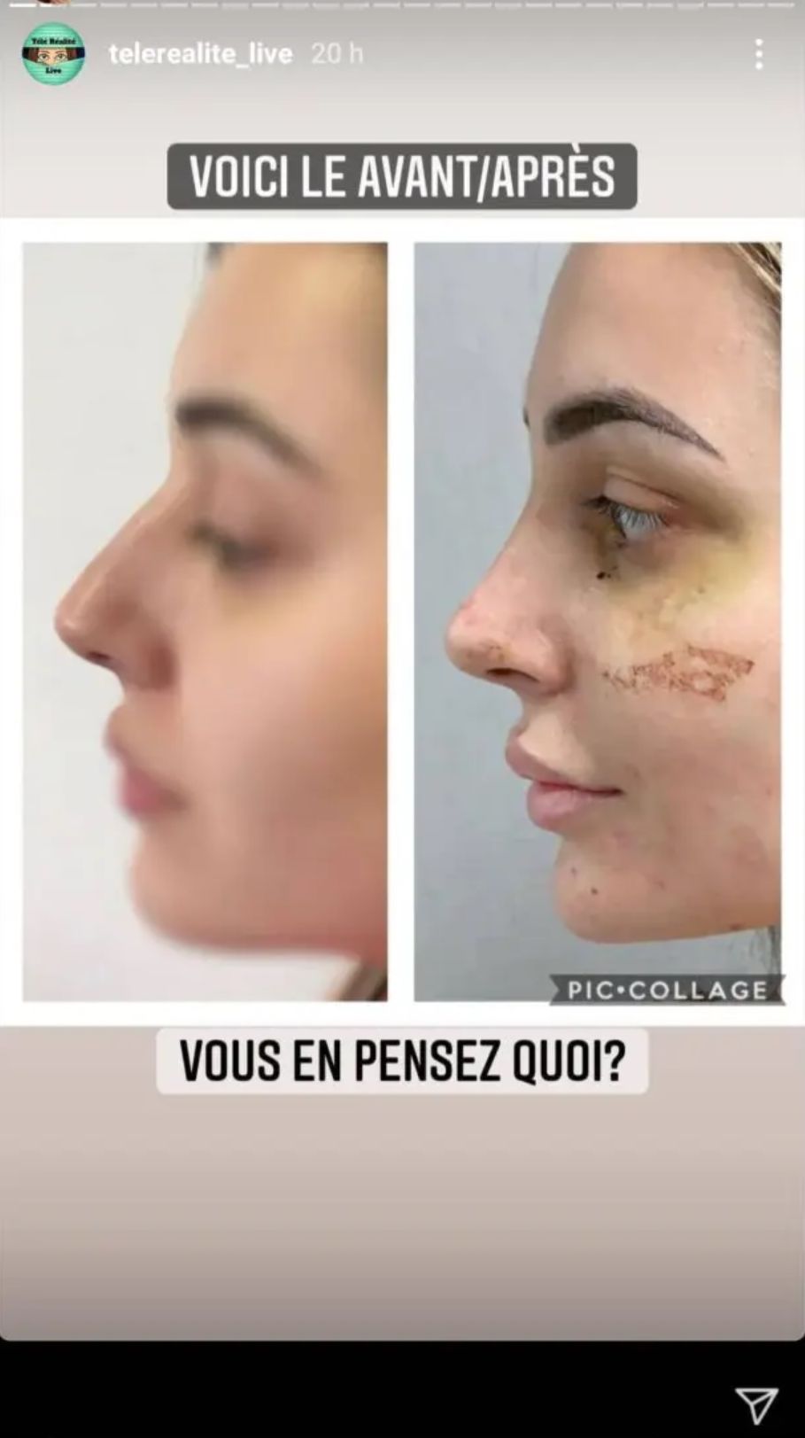 Léa Mary (10 Couples Parfaits) : La compagne de SebyDaddy dévoile le résultat de sa rhinoplastie !