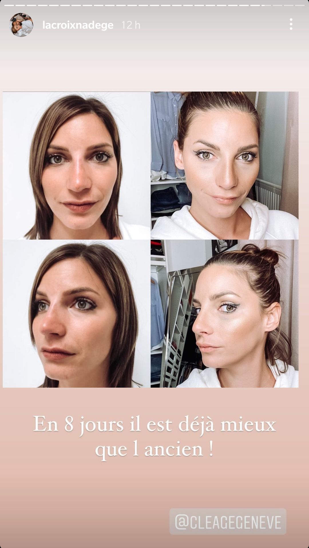 Nadège Lacroix métamorphosée : Elle dévoile le résultat de sa rhinoplastie !