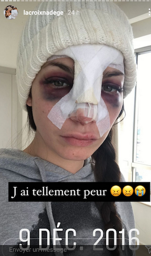 Nadège Lacroix s'offre une nouvelle rhinoplastie et appréhende le résultat