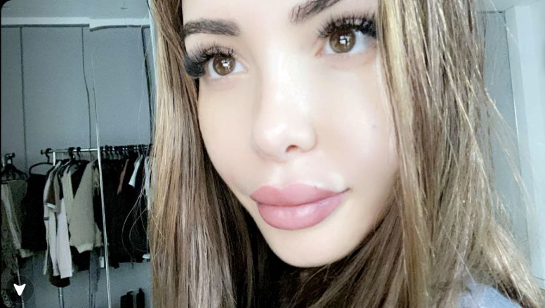  Nabilla exhibe fièrement ses nouvelles lèvres. Credit: Snapchat / Nabilla.V