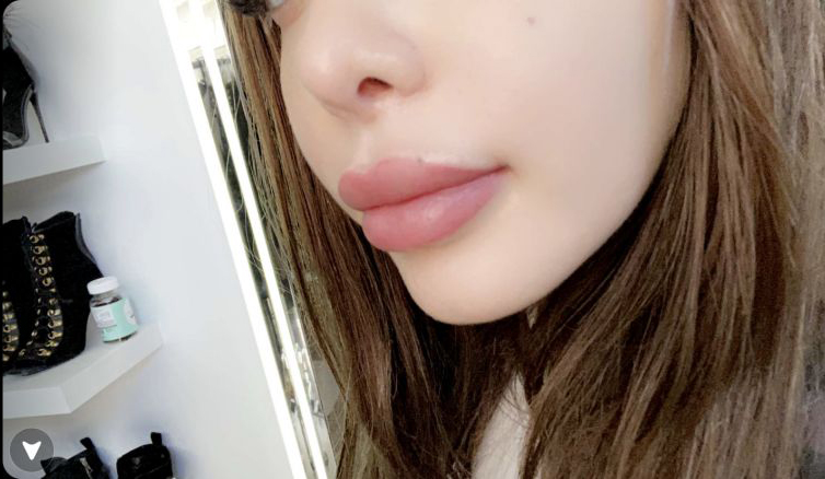  Nabilla exhibe fièrement ses nouvelles lèvres. Credit: Snapchat / Nabilla.V