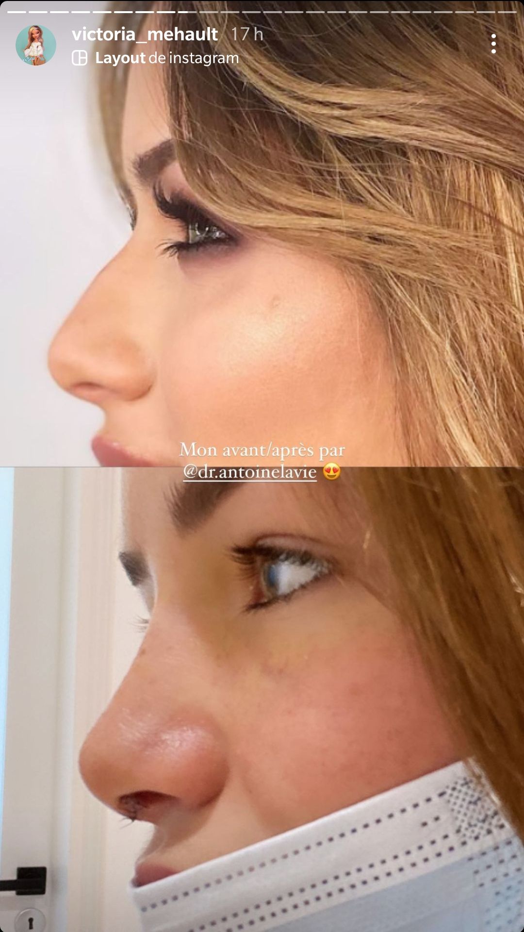 Victoria Mehault (LMAD) métamorphosée : Elle dévoile le résultat de sa rhinoplastie !