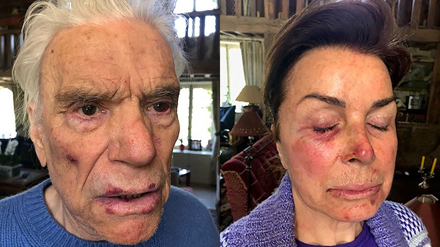  Les visages de Bernard et Dominique Tapie après leur violente agression @AFP - Family Handout