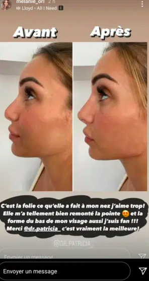  Mélanie Orl très fière de son nouveau nez @Instagram