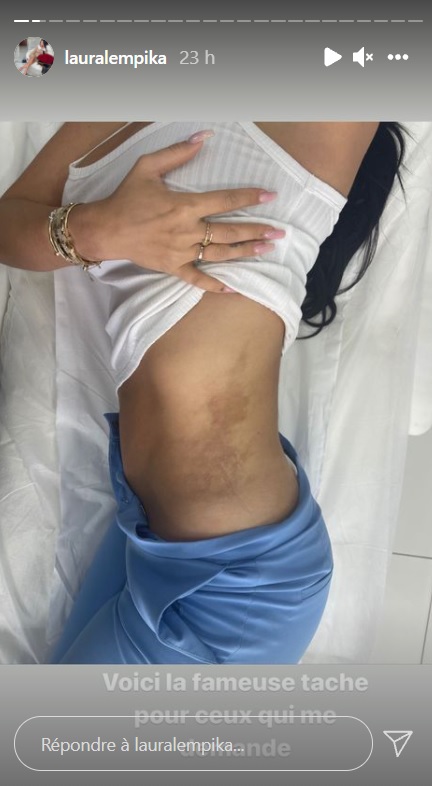 Laura Lempika marquée à cause d'une chirurgie esthétique ratée : La photo choc