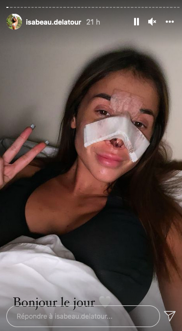  Isabeau Delatour après sa rhinoplastie @Instagram