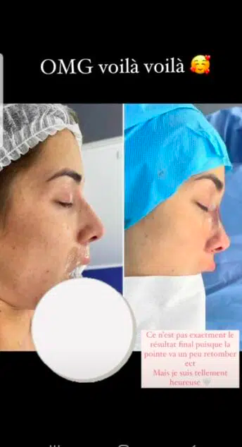  Isabeau Delatour après sa rhinoplastie @Instagram