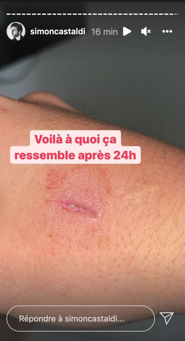  La blessure à la main de Simon Castaldi @Instagram
