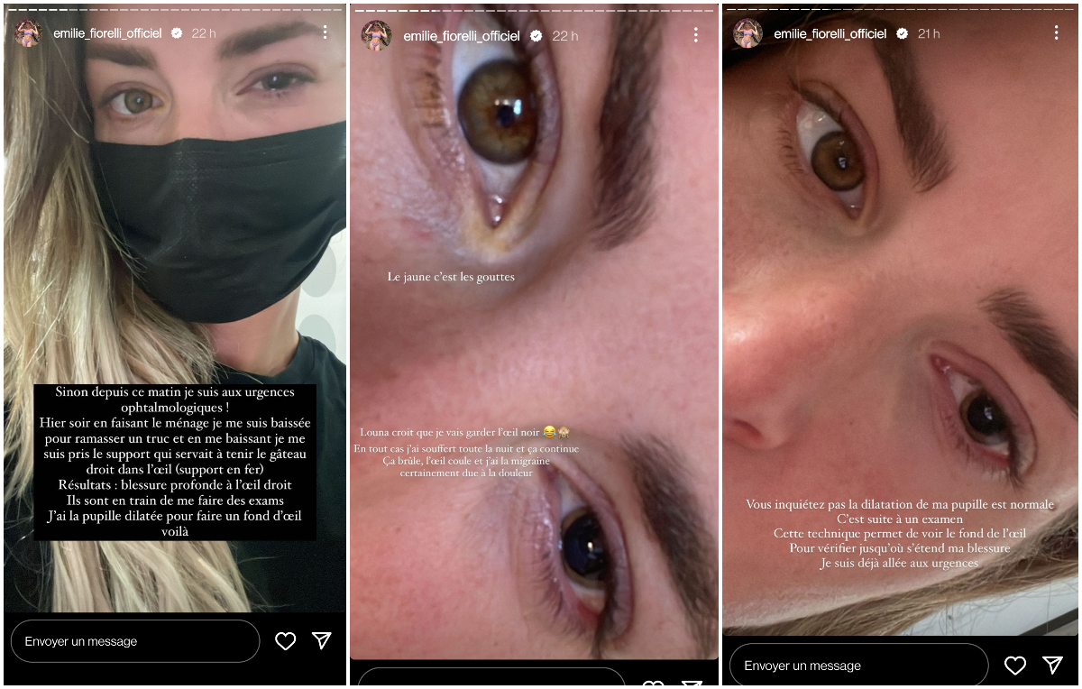 Emilie Fiorelli victime d'un accident domestique : "J'ai une plaie profonde sous la paupière"