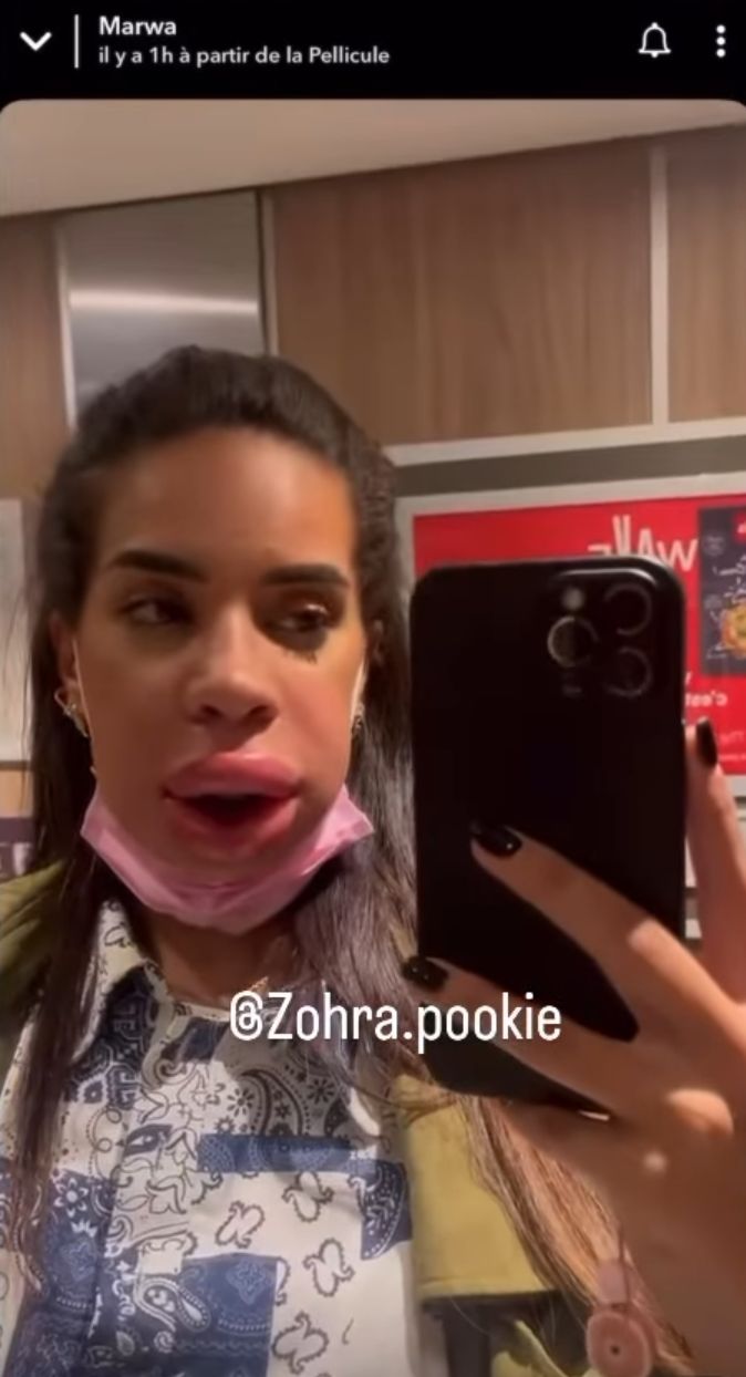 Marwa Merazka les lèvres ultra gonflées : elle dévoile sa réaction allergique aux injections