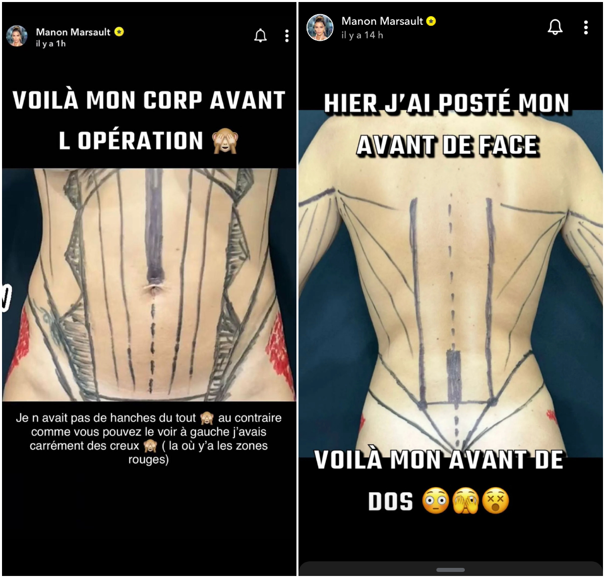 Manon Marsault dévoile un avant/après sa dernière chirurgie esthétique !