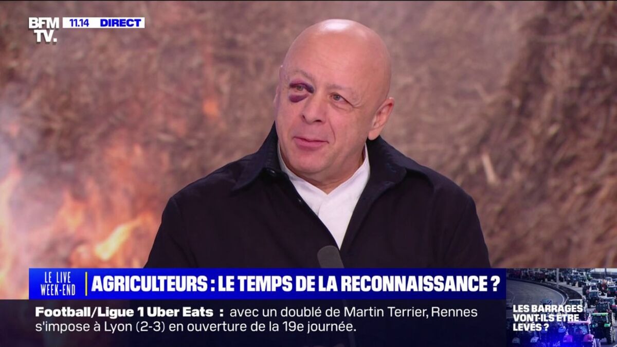 Thierry Marx apparaît avec un impressionnant œil au beurre noir : il s’explique sur sa blessure