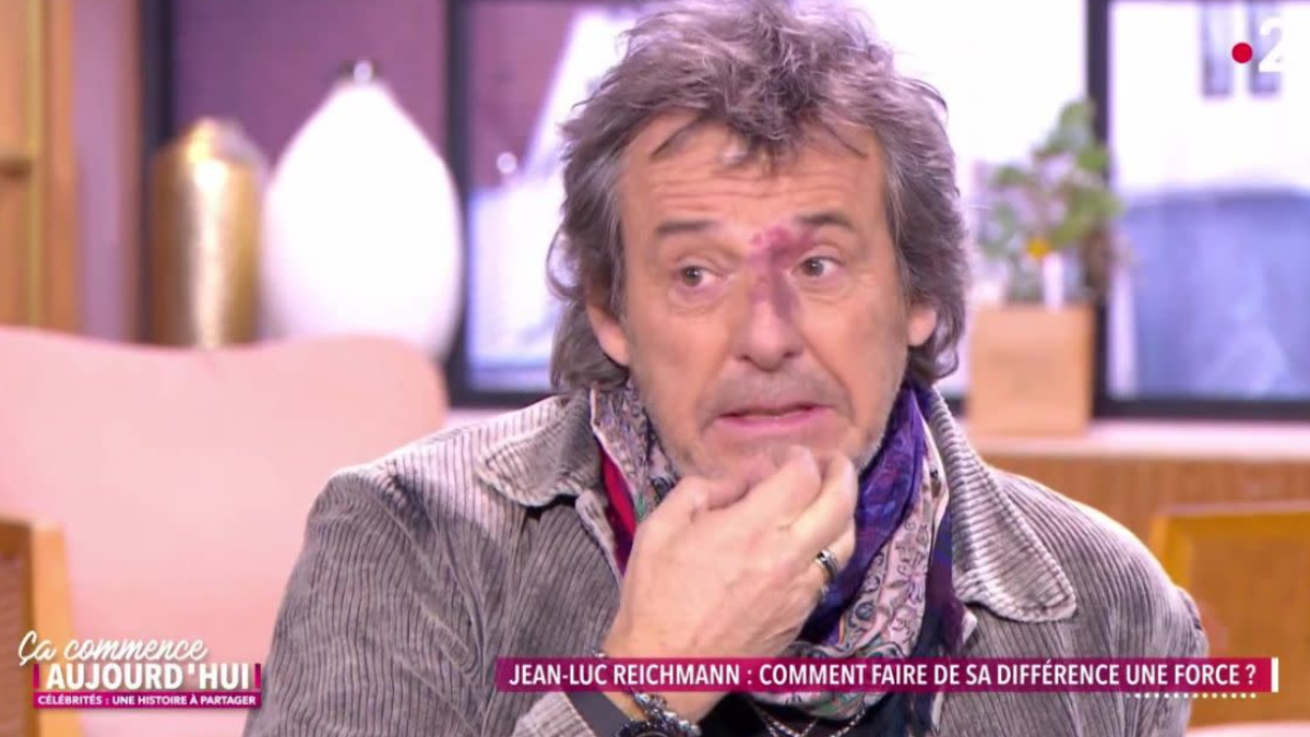 Jean-Luc Reichmann sur les remarques sur son angiome au visage : &quot;On m’appelait 'nez râpé'&quot;
