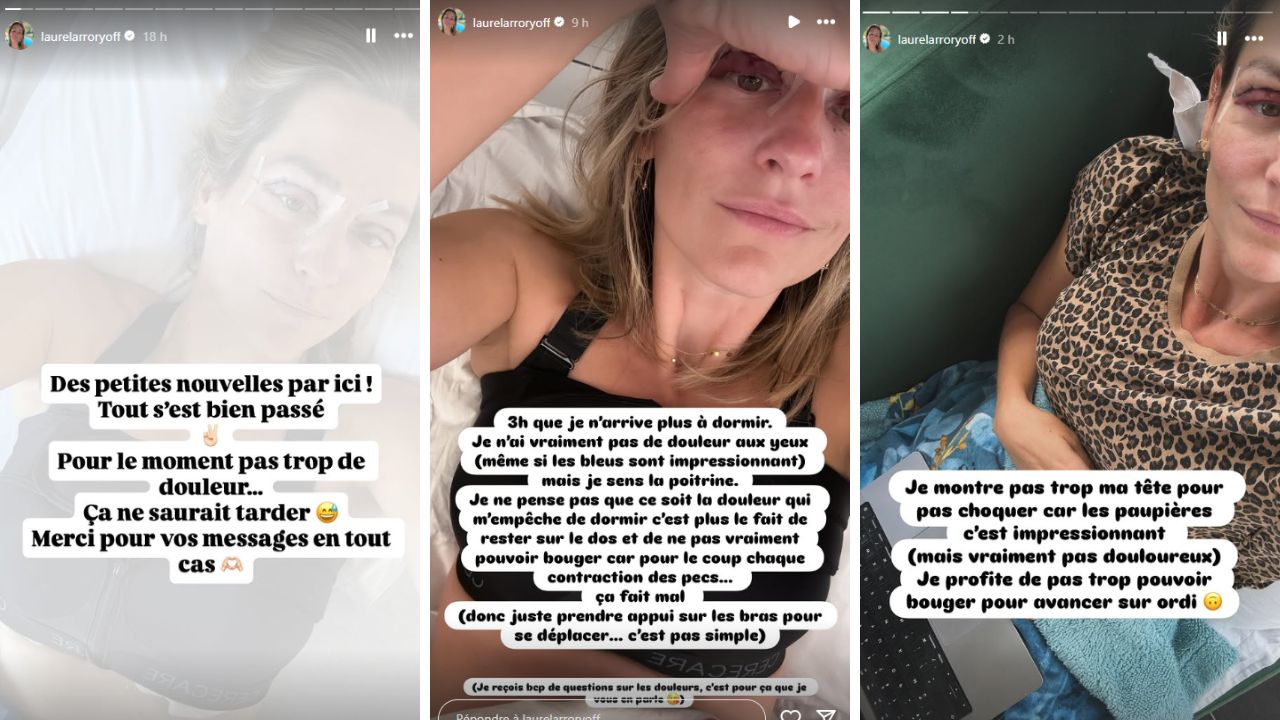 Laure (Mariés au premier regard) dévoile les premiers résultats de ses opérations esthétiques