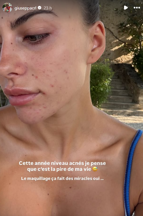 "La pire de ma vie" : Giuseppa Ciurleo s’affiche sans maquillage et dévoile son acné
